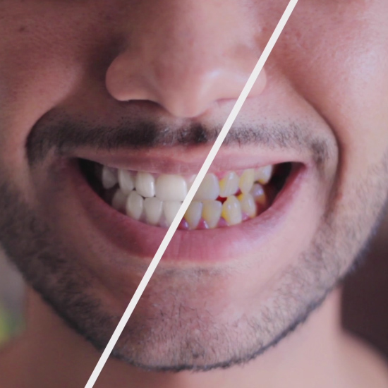 Smiling man before and after teeth whitening